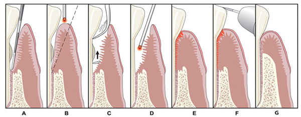 Laser Assisted Surgery Lanap Dentist In Fountain Valley Ca Socal Prosthodontics Of Fountain Valley